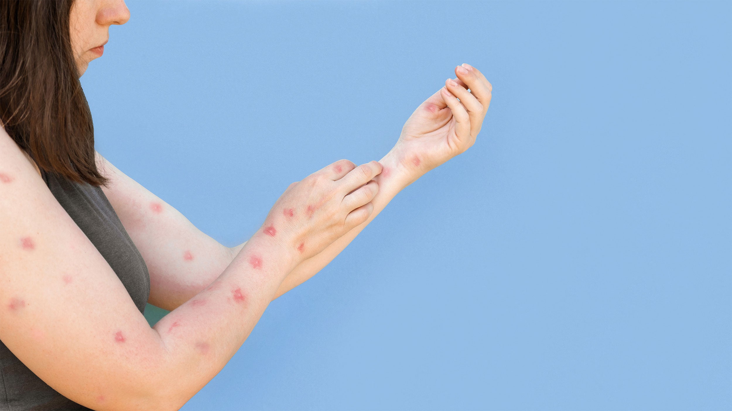 Monkey Box Rash MonkeyPox and its impact on EMS – Endure Industries
